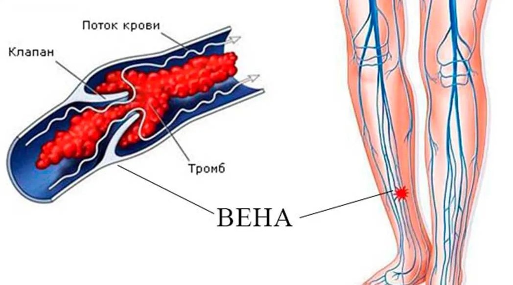 Файл:Hallux Valgus-Aspect pré op décharge.JPG - Википедия