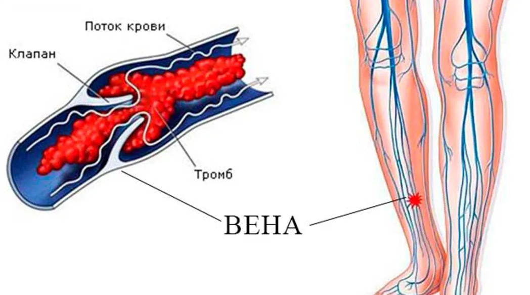 Тромбоэмболия после операции. Илеофеморальный венозный тромб. Поверхностный флебит, тромбофлебит. Тромбоз глубоких вен нижних конечностей рисунок.