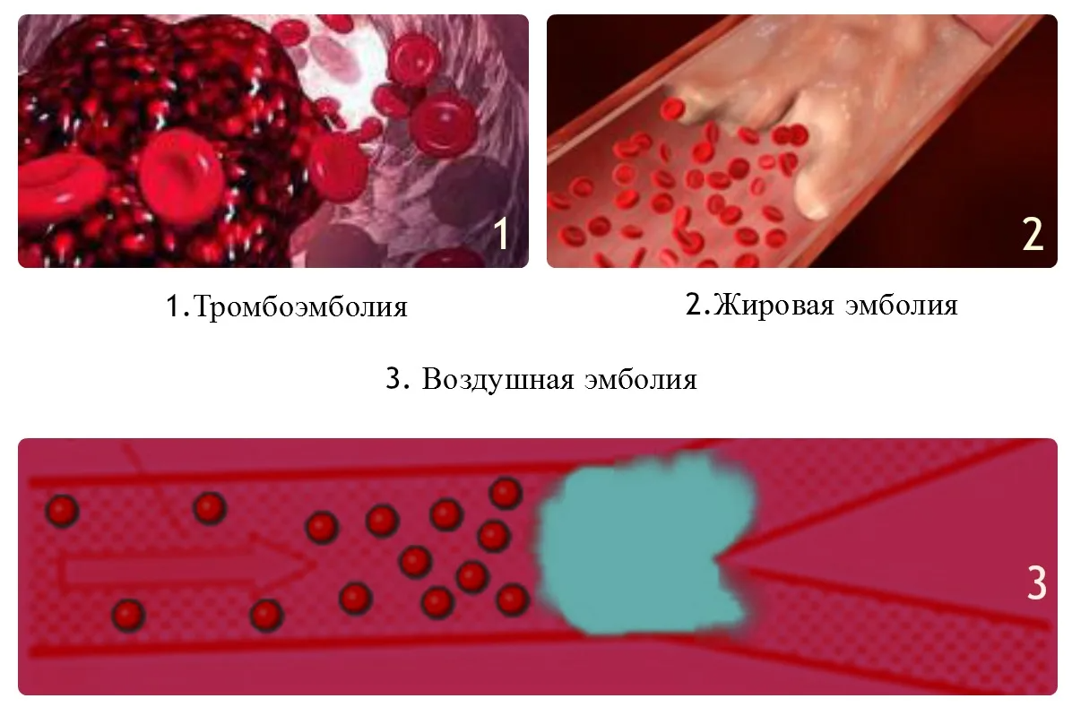 Кровь закупорка сосудов